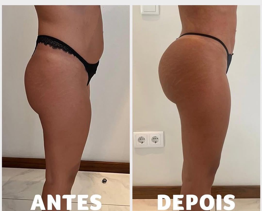 Antes e depois de procedimento estético — Dream Body Clinic